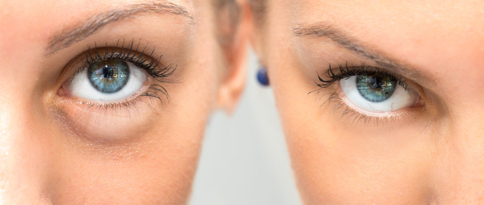 Excess upper eyelid skin before blepharoplasty