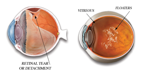 vitreous humor floaters