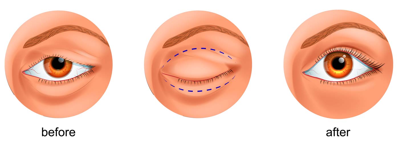 Blepharoplasty eyelid surgery at Newsom Eye