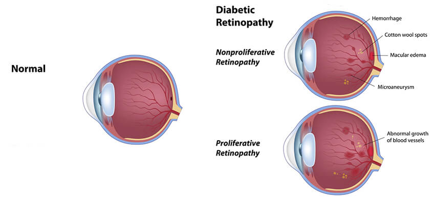 Comparison of a healthy retina and one with diabetic retinopathy