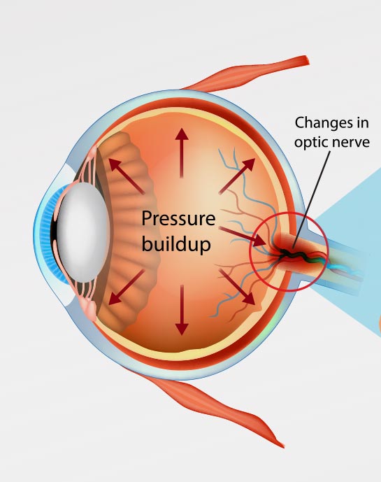 The trabecular meshwork, where the iStent restores drainage
