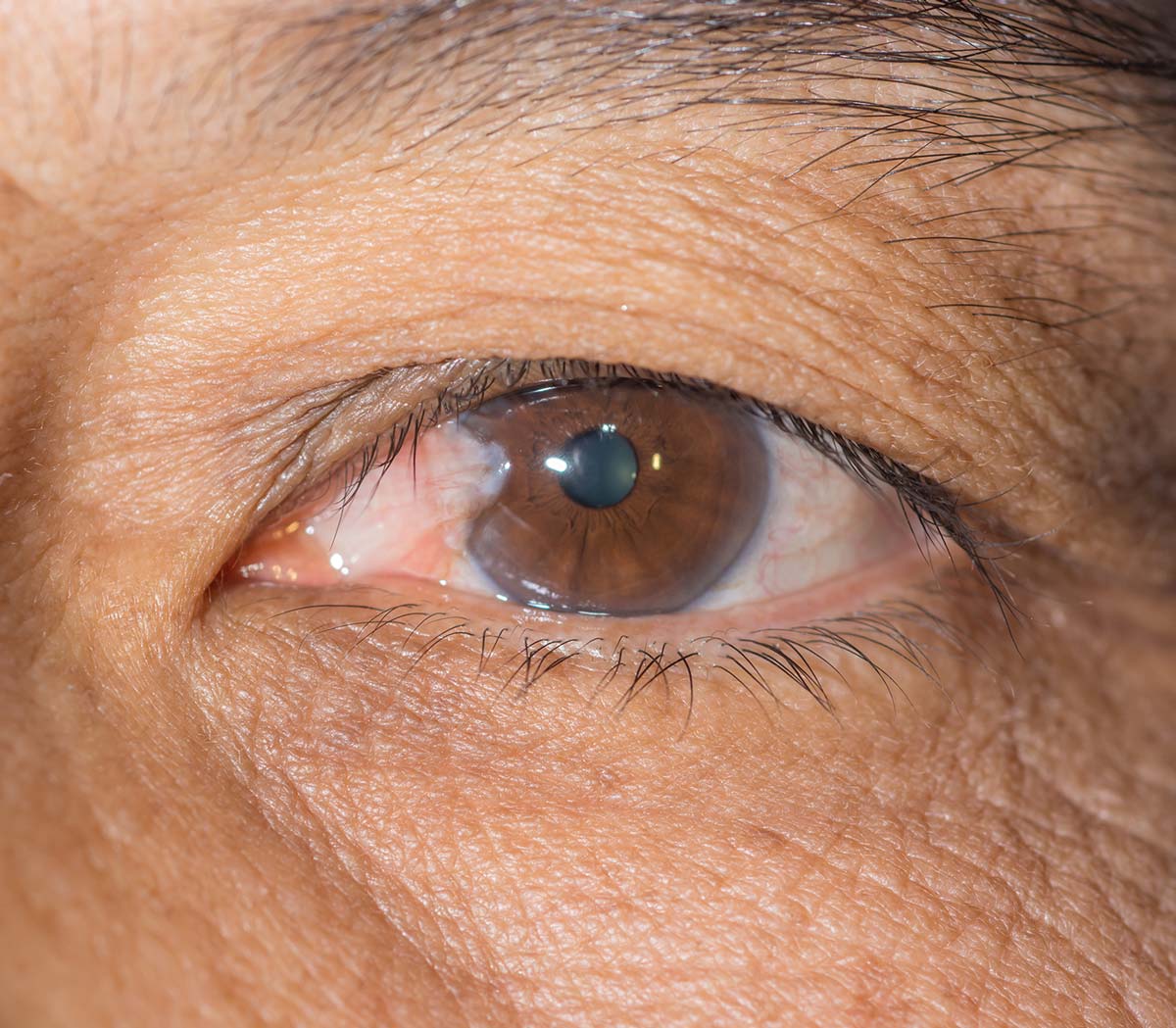 Pterygium growing over the cornea