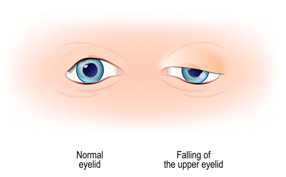 Ptosis, a drooping upper eyelid